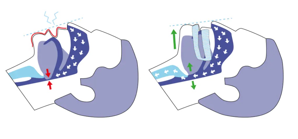 капа от храпа