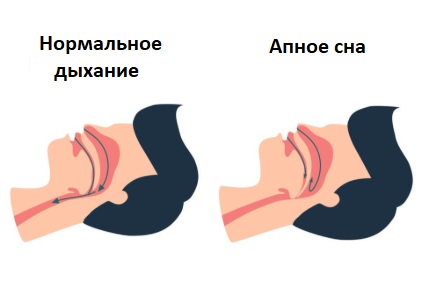 Апное сна